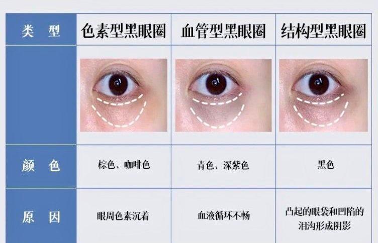「健康科普：你的黑眼圈是属于哪一种类型？」很多人都有黑眼圈,它也是睡眠不好的代价之一，以下3种类型，想要消除需要先“对症”：①色素型：棕色、咖啡色