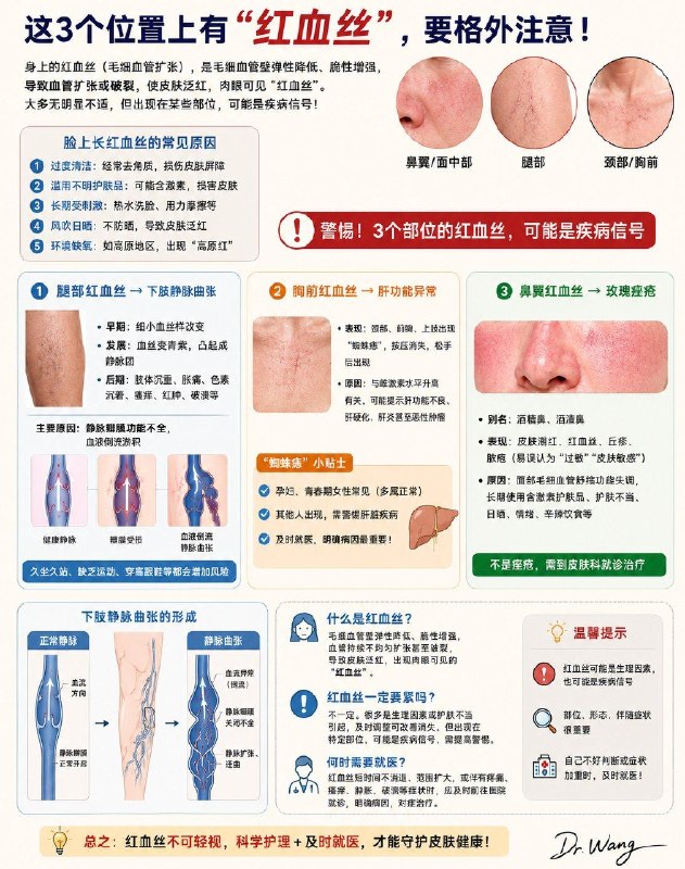 「医学科普：身上这3处出现“红血丝”可能不是皮肤问题 而是疾病信号！」仔细看看你的脸上或腿上，有没有一些红血丝？有的红血丝单独出现，有的则会密集分布，大多都没有明显的不舒服……身上的红血丝是什么？是提示身体出问题了吗？大部分人身上都出现过红血丝，尤其在脸上，最常见的一种情况是“毛细血管扩张症”