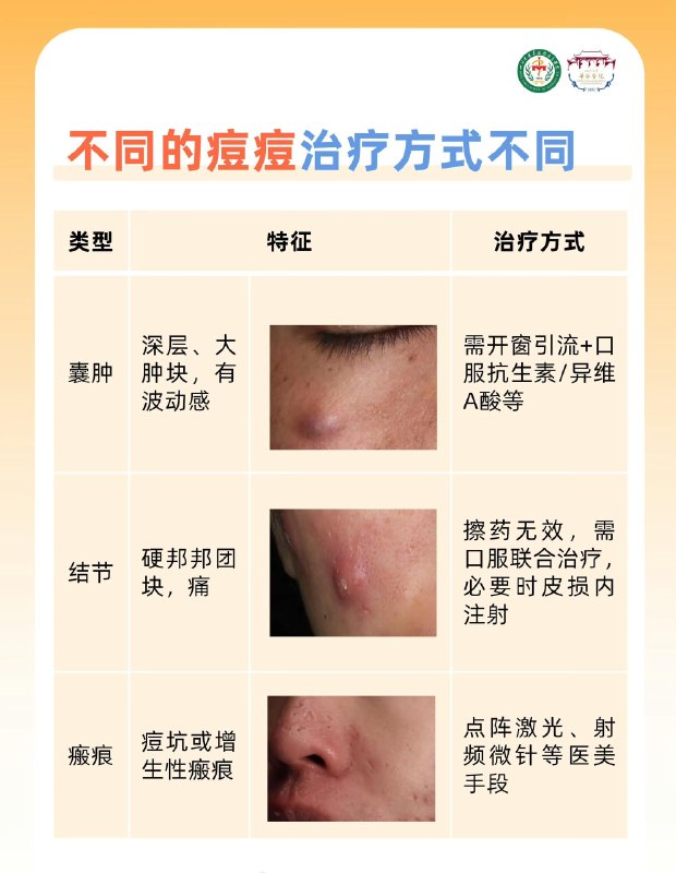 「医学科普：痘痘贴、戒牛奶、忌辣椒 哪个方法“战痘”更有效？」 ​​​credit by:川大华西医科「医学科普：痘痘贴、戒牛奶、忌辣椒 哪个方法“战痘”更有效？」 ​​​credit by:川大华西医科