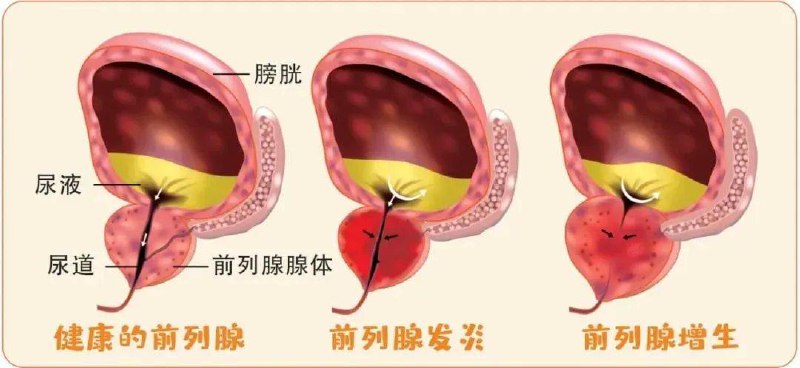 每天跳一跳，给前列腺“减减压”前列腺是男性生殖系统的关键器官，长期久坐、缺乏运动易引发盆腔充血，进而诱发各类前列腺问题