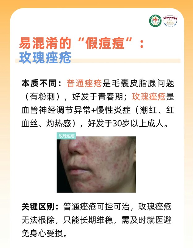 「医学科普：痘痘贴、戒牛奶、忌辣椒 哪个方法“战痘”更有效？」 ​​​credit by:川大华西医科「医学科普：痘痘贴、戒牛奶、忌辣椒 哪个方法“战痘”更有效？」 ​​​credit by:川大华西医科