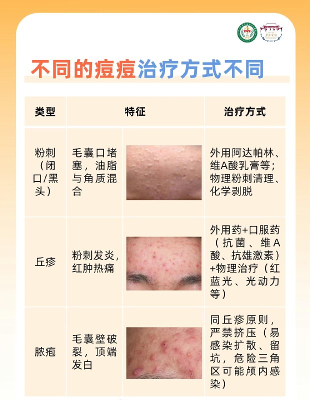 「医学科普：痘痘贴、戒牛奶、忌辣椒 哪个方法“战痘”更有效？」 ​​​credit by:川大华西医科「医学科普：痘痘贴、戒牛奶、忌辣椒 哪个方法“战痘”更有效？」 ​​​credit by:川大华西医科